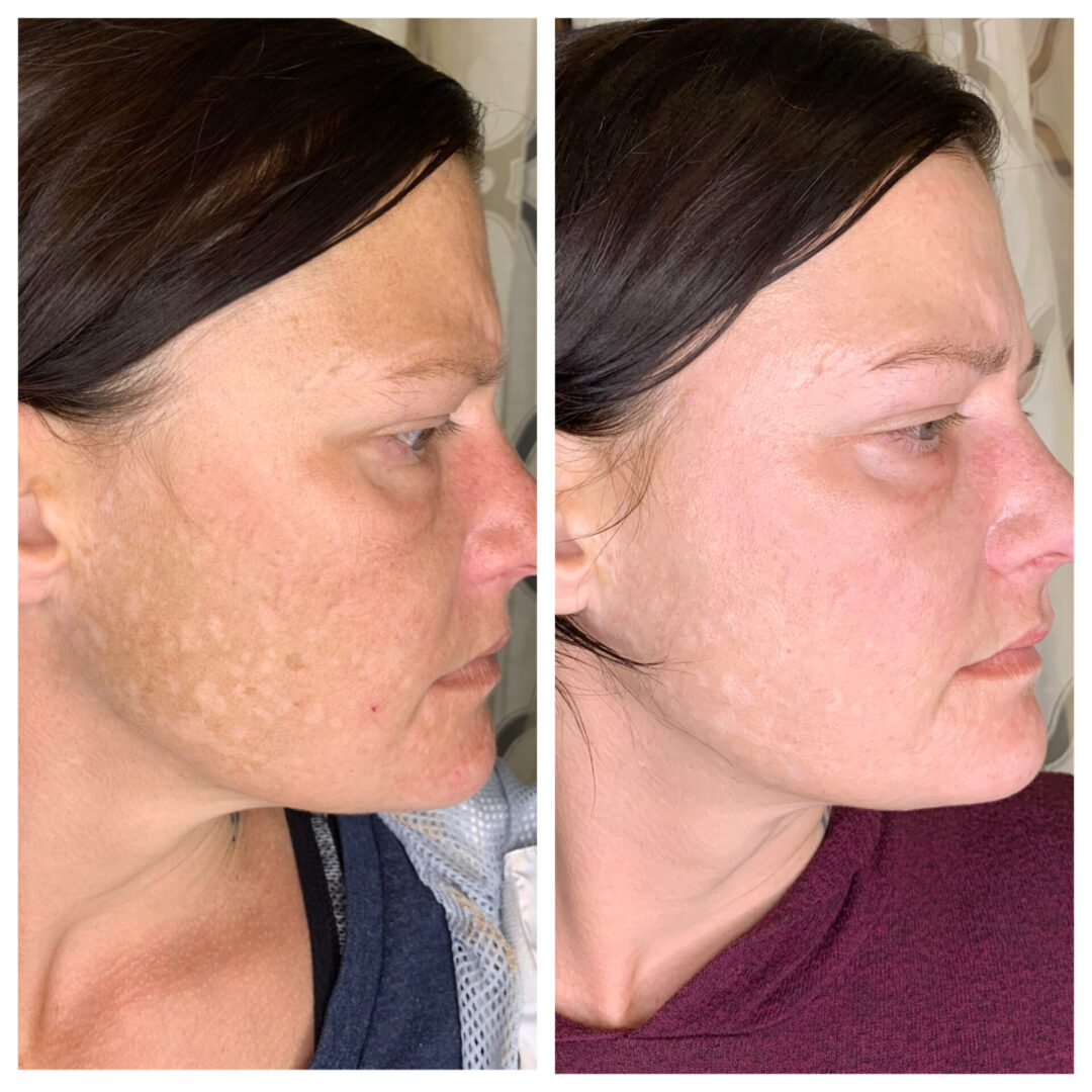The Before and After Treatment