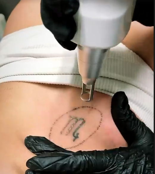 Laser Tattoo Removal  Cosmetic Rejuvenation Center