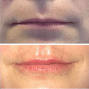 Brighter Smiles Oregon Med Spa Laser Wellness Center for Silk Injection Treatments Before and After Lip Review in Eugene Oregon