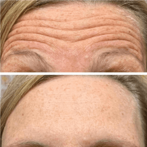 Brighter Smiles Oregon Med Spa and Wellness Laser Center Dysport Procedures Treatments Before and After Photo in Eugene Oregon 2