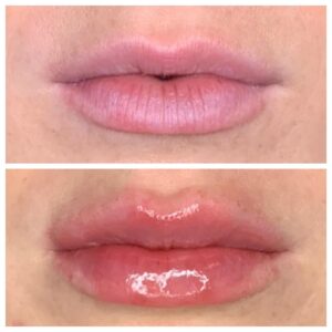 Brighter Smiles Oregon Med Spa and Wellness Laser Center Juvederm® Injectable Procedures Treatments in Eugene Oregon Before and After H