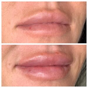 Brighter Smiles Oregon Med Spa and Wellness Laser Center Juvederm® Injectable Procedures Treatments in Eugene Oregon Before and After K