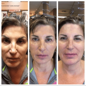 Brighter Smiles Oregon Med Spa and Wellness Laser Center Voluma Procedures and Treatments in Eugene Oregon Before and After C