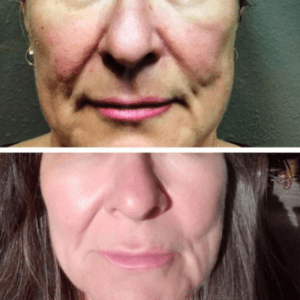 Brighter Smiles Oregon Med Spa and Wellness Laser Center Voluma® Injectable Before and After Cheek Augmentation in Eugene Oregon A