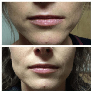 Brighter Smiles Oregon Med Spa and Laser Center in Eugene Oregon Lip Flip Injectable Before and After Photos 2