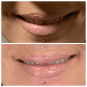 Brighter Smiles Oregon Med Spa and Laser Center in Eugene Oregon Lip Flip Injectable Before and After Photos 3