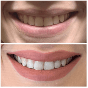 Brighter Smiles Oregon Med Spa and Laser Center in Eugene Oregon Lip Flip Injectable Before and After Photos 4