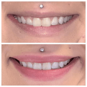 Brighter Smiles Oregon Med Spa and Laser Center in Eugene Oregon Lip Flip Injectable Before and After Photos 5