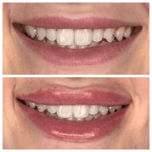 Brighter Smiles Oregon Med Spa and Laser Center in Eugene Oregon Lip Flip Injectable Before and After Photos 6