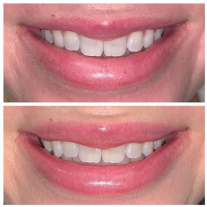 Brighter Smiles Oregon Med Spa and Laser Center in Eugene Oregon Lip Flip Injectable Before and After Photos 7