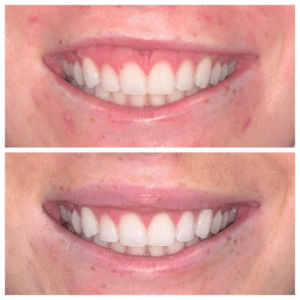 Brighter Smiles Oregon Med Spa and Laser Center in Eugene Oregon Lip Flip Injectable Before and After Photos 8