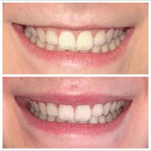 Brighter Smiles Oregon Med Spa and Laser Center in Eugene Oregon Lip Flip Injectable Before and After Photos 9