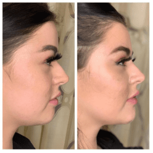 Brighter Smiles Award Winning Med Spa offers Liquid Rhinoplasty Derma Filler Nose Correction Treatments in Eugene Springfield Oregon Before and After