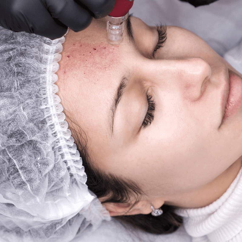 Brighter Smiles an Oregon Med Spa and Laser Center in Eugene Oregon offers Collagen Induction Therapy