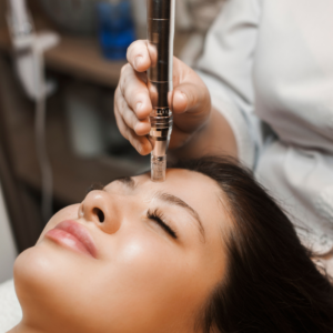 Brighter Smiles an Oregon Med Spa and Laser Center in Eugene Oregon offers Collagen Induction Therapy Procedure