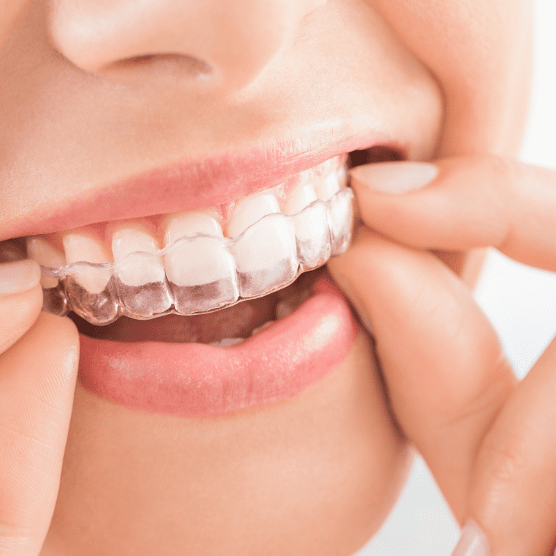 Brighter Smiles an Oregon Med Spa and Laser Center in Eugene Oregon offers Custom Fitted Teeth Whitening Trays with Bleaching Gel