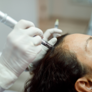 Brighter Smiles an Oregon Med Spa and Laser Center in Eugene Oregon offers Customized Microneedling Hair Restoration Treatment
