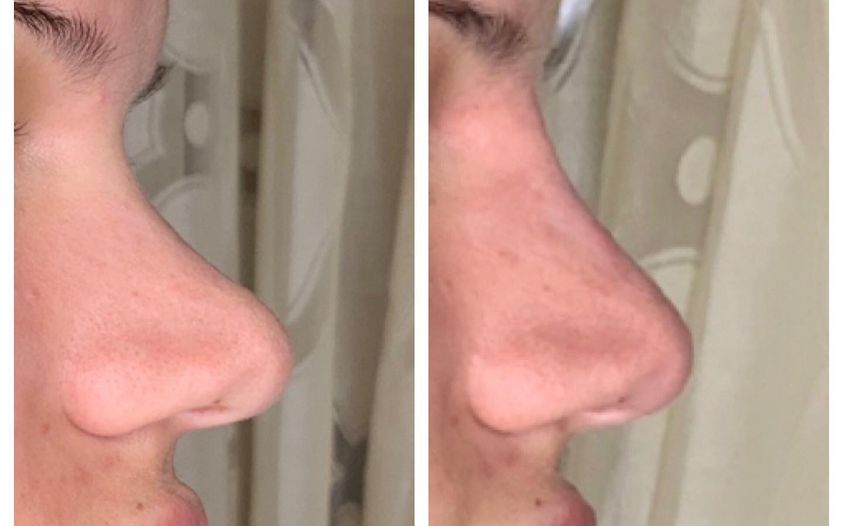 Brighter Smiles Med Spa Injectables for the liquid rhinoplasty treatment, Eugene Oregon
