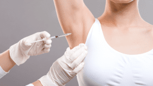 Botox for underarm sweating - hyperhydrosis