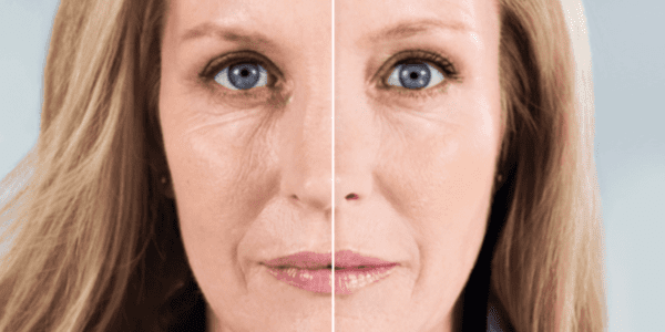 Caucasian woman left side before sculptra right side after