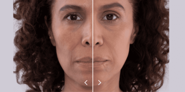 woman with dark curly hair, left side before 4 vials of sculptra, right side 4 months later after