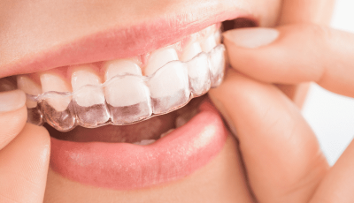 Brighter Smiles an Oregon Med Spa and Laser Center in Eugene Oregon offers Custom Fitted Teeth Whitening Trays with Bleaching Gel